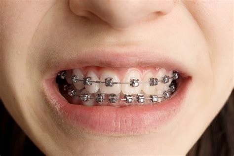 How Long Do Rubber Bands on Braces Hurt: Exploring the Discomfort and Beyond